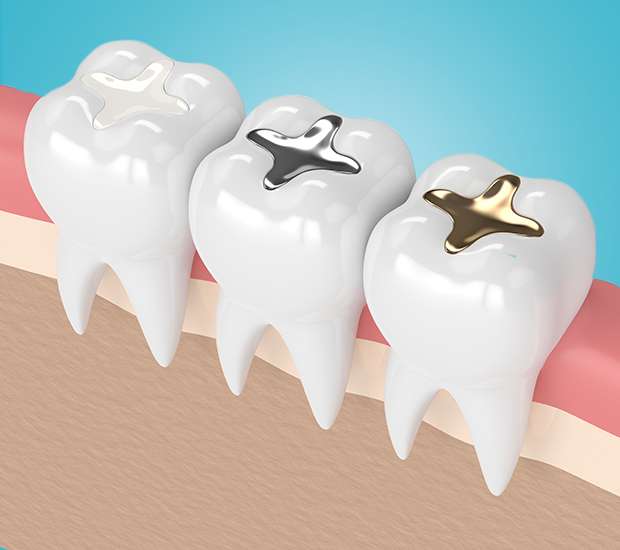 Pembroke Pines Composite Fillings
