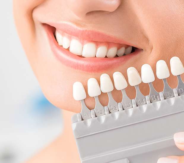 Pembroke Pines Dental Veneers and Dental Laminates